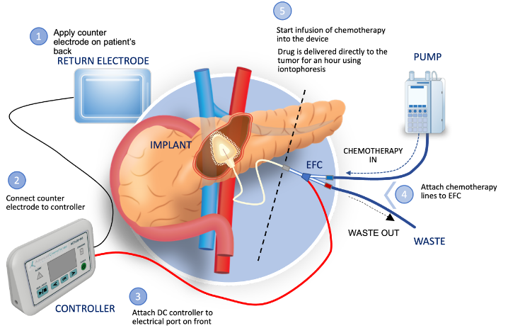 Focal Medical's precision therapeutic system to deliver gemcitabine to the pancreas.